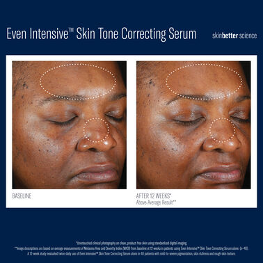Even Intensive Skin Tone Correcting Serum -  | L'Oréal Dermatological Beauty Partner Shop