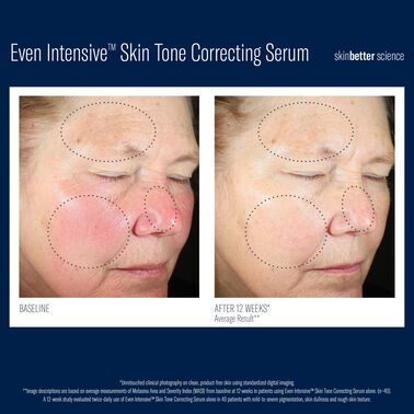 Even Intensive Skin Tone Correcting Serum -  | L'Oréal Dermatological Beauty Partner Shop