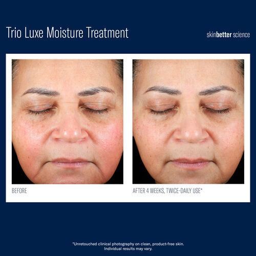 Trio Luxe Moisture Treatment - skinbetter science | 欧莱雅皮肤美容合作店