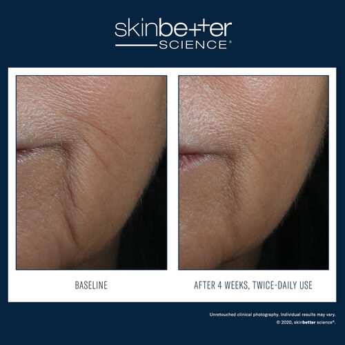 Interfuse Intensive Treatment LINES - Signs of Aging | L'Or&eacute;al Dermatological Beauty Partner Shop