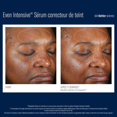 Even Intensive Sérum correcteur de teint -  | L'Oréal Dermatological Beauty Partner Shop