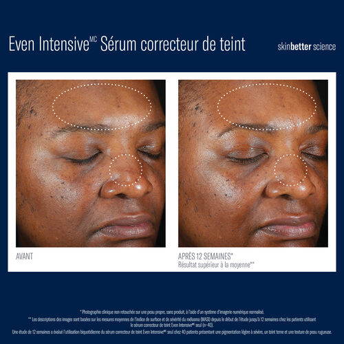 Even Intensive S&eacute;rum correcteur de teint - Pigmentation | L'Or&eacute;al Dermatological Beauty Partner Shop