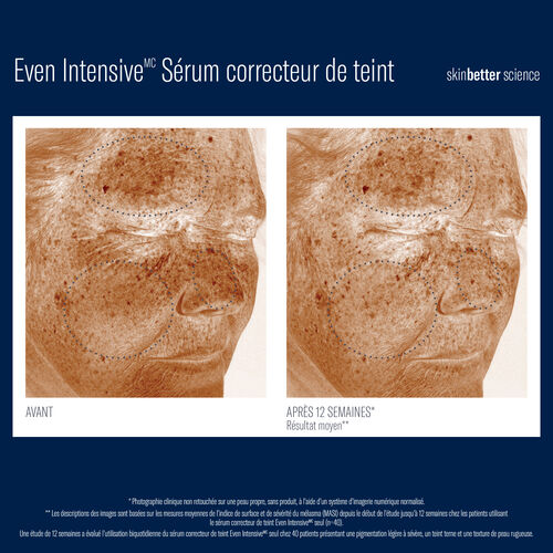 Even Intensive S&eacute;rum correcteur de teint - Pigmentation | L'Or&eacute;al Dermatological Beauty Partner Shop