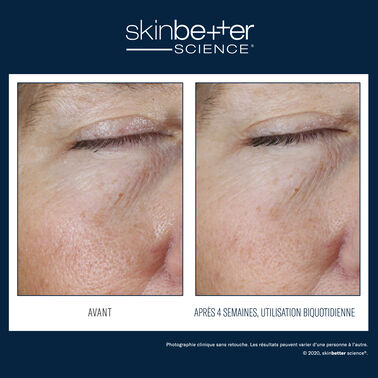 Gel effet instantané Yeux - Tendance Acnéique | L'Oréal Dermatological Beauty Partner Shop