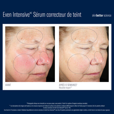 Even Intensive Sérum correcteur de teint -  | L'Oréal Dermatological Beauty Partner Shop